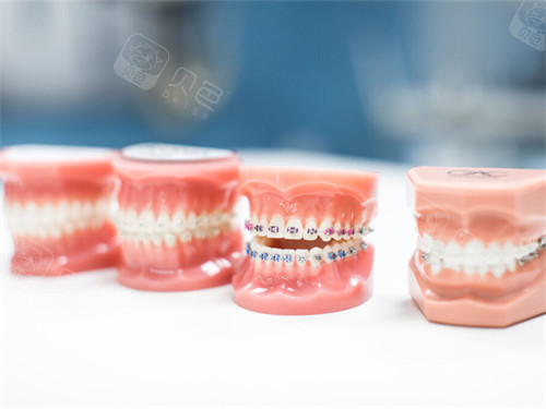 学生牙齿矫正多少钱？2024年不同矫正方式价格在8000元到500元起!(图3)