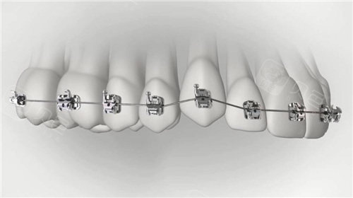 想知道2024牙齿矫正多少钱价格表吗？整理了详细矫正价格表传统钢丝托槽自锁托槽隐形等!(图2)