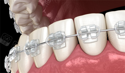 想知道2024牙齿矫正多少钱价格表吗？整理了详细矫正价格表传统钢丝托槽自锁托槽隐形等!(图4)