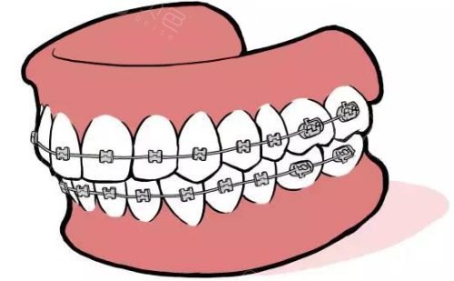 想知道2024牙齿矫正多少钱价格表吗？整理了详细矫正价格表传统钢丝托槽自锁托槽隐形等!(图3)