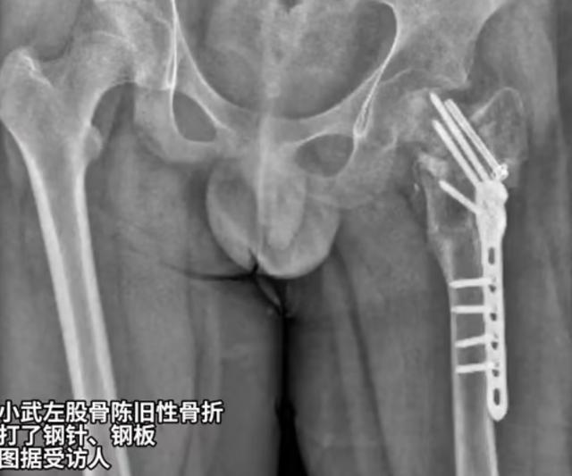 男孩在矫正基地被虐待28天致半残疾该基地号称专治厌学、网瘾对孩子经常殴打、关小黑屋(图2)